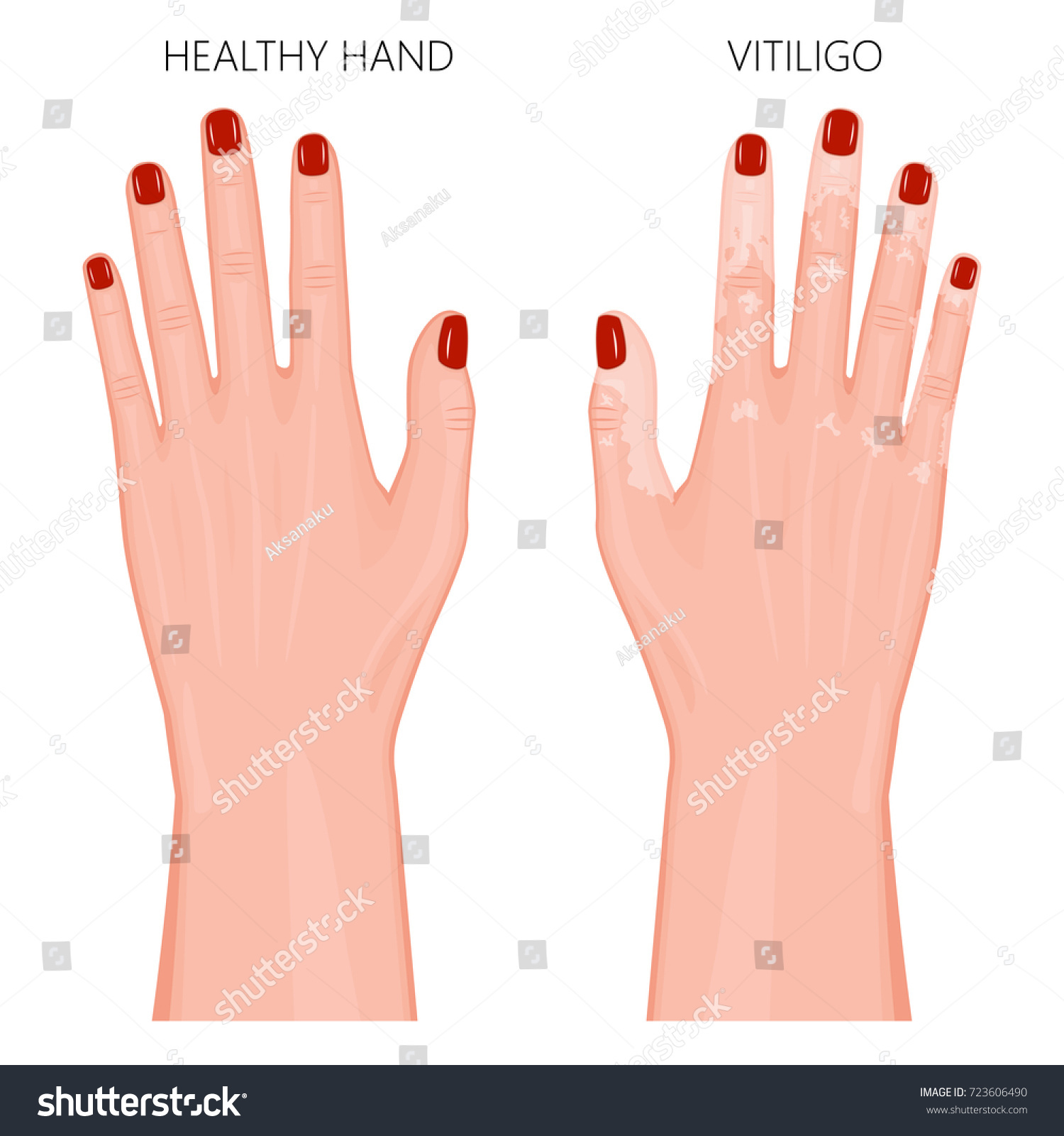 skin color tattoo vitiligo vitiligo treatment by microart semi skin color tattoo vitiligo vitiligo treatment by microart semi