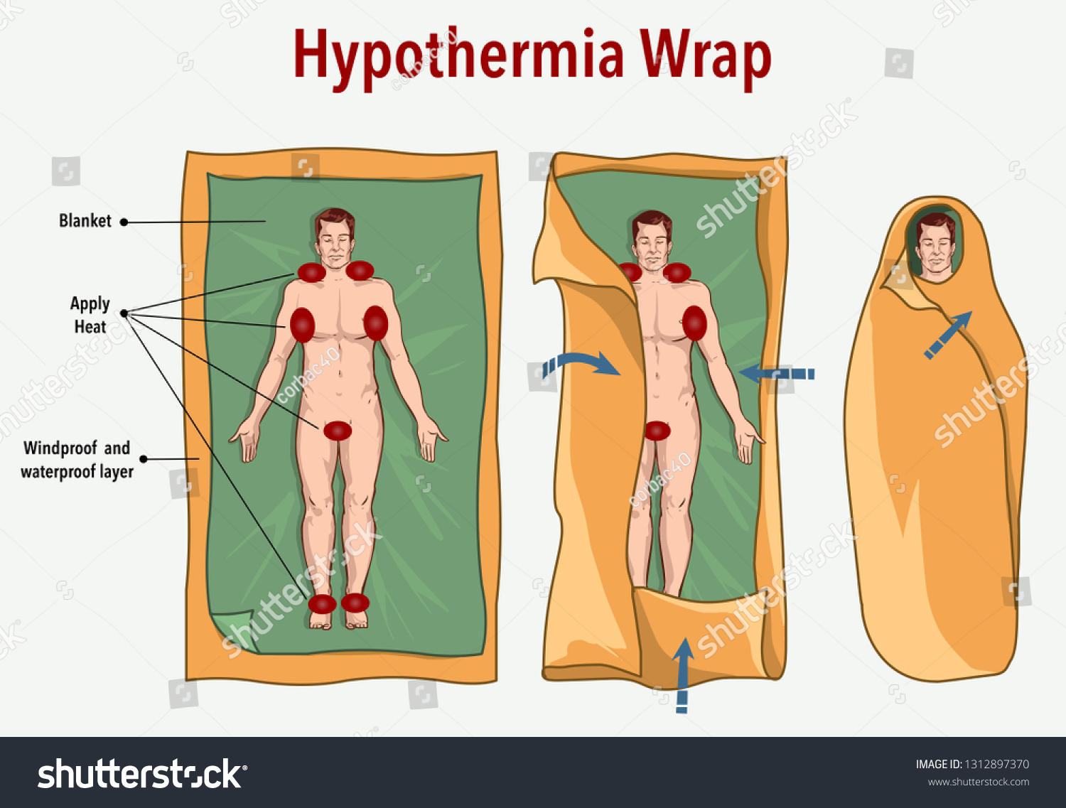 Hypothermia Hypothermia: Signs,