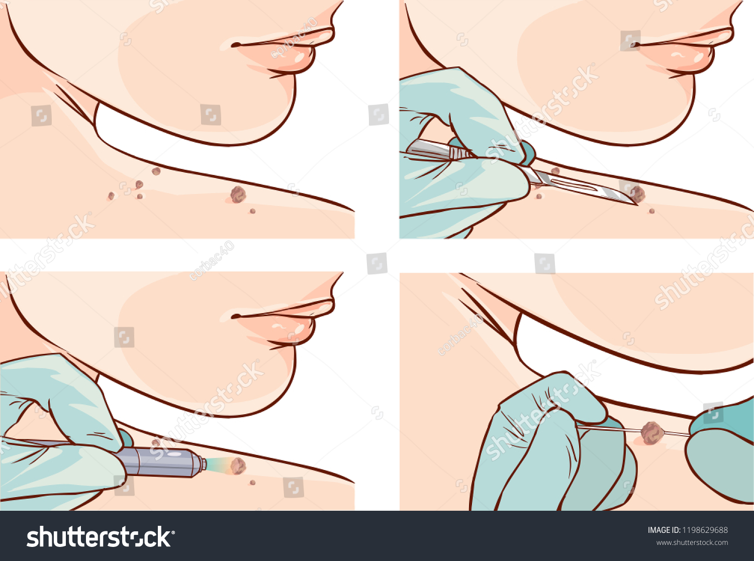 Vector Illustration Skin Tag Removal Methods Stock Vector (Royalty Free) 1198629688