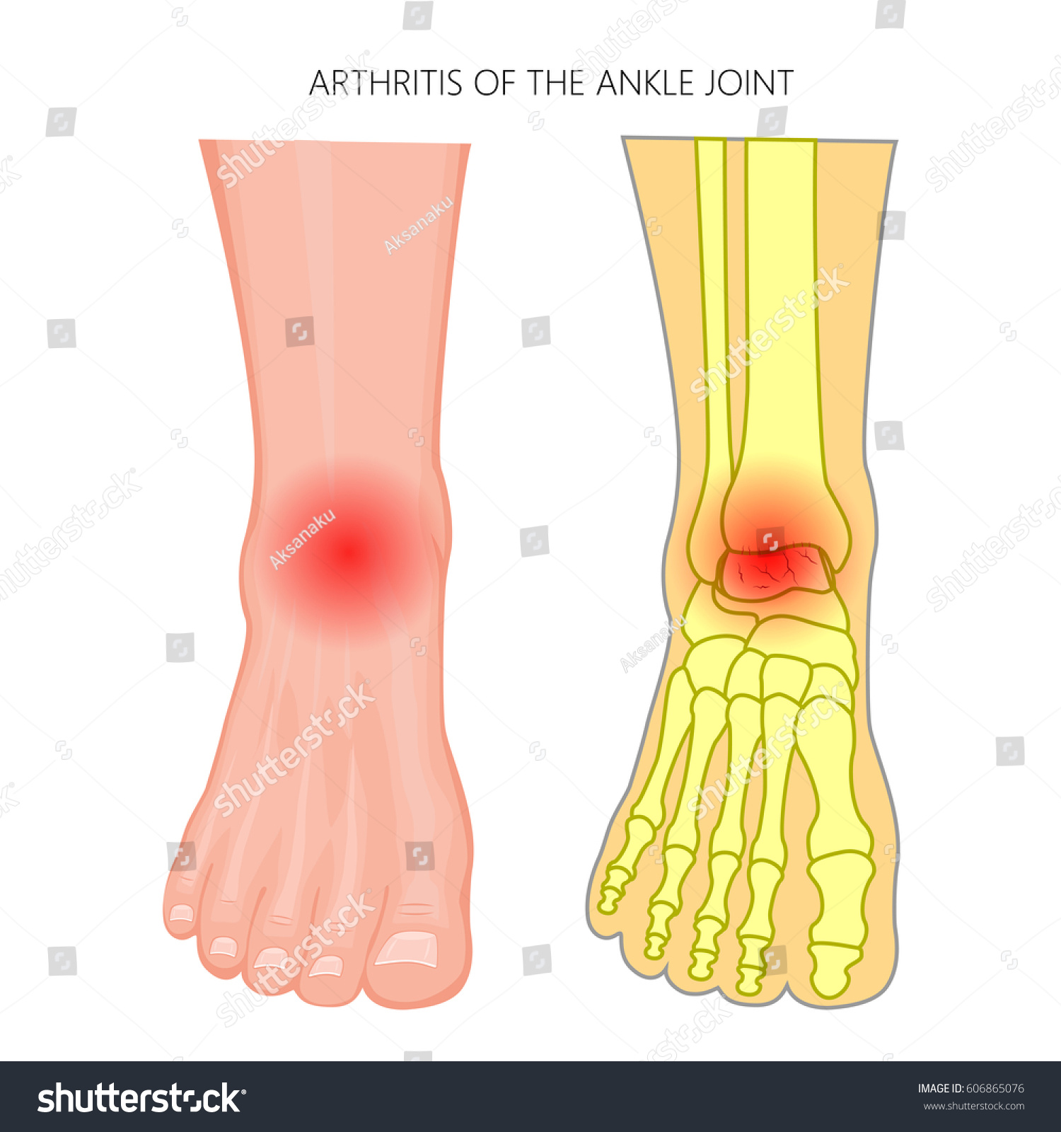 Vector Illustration Arthritis Ankle Joint Front Stock Vector (Royalty ...