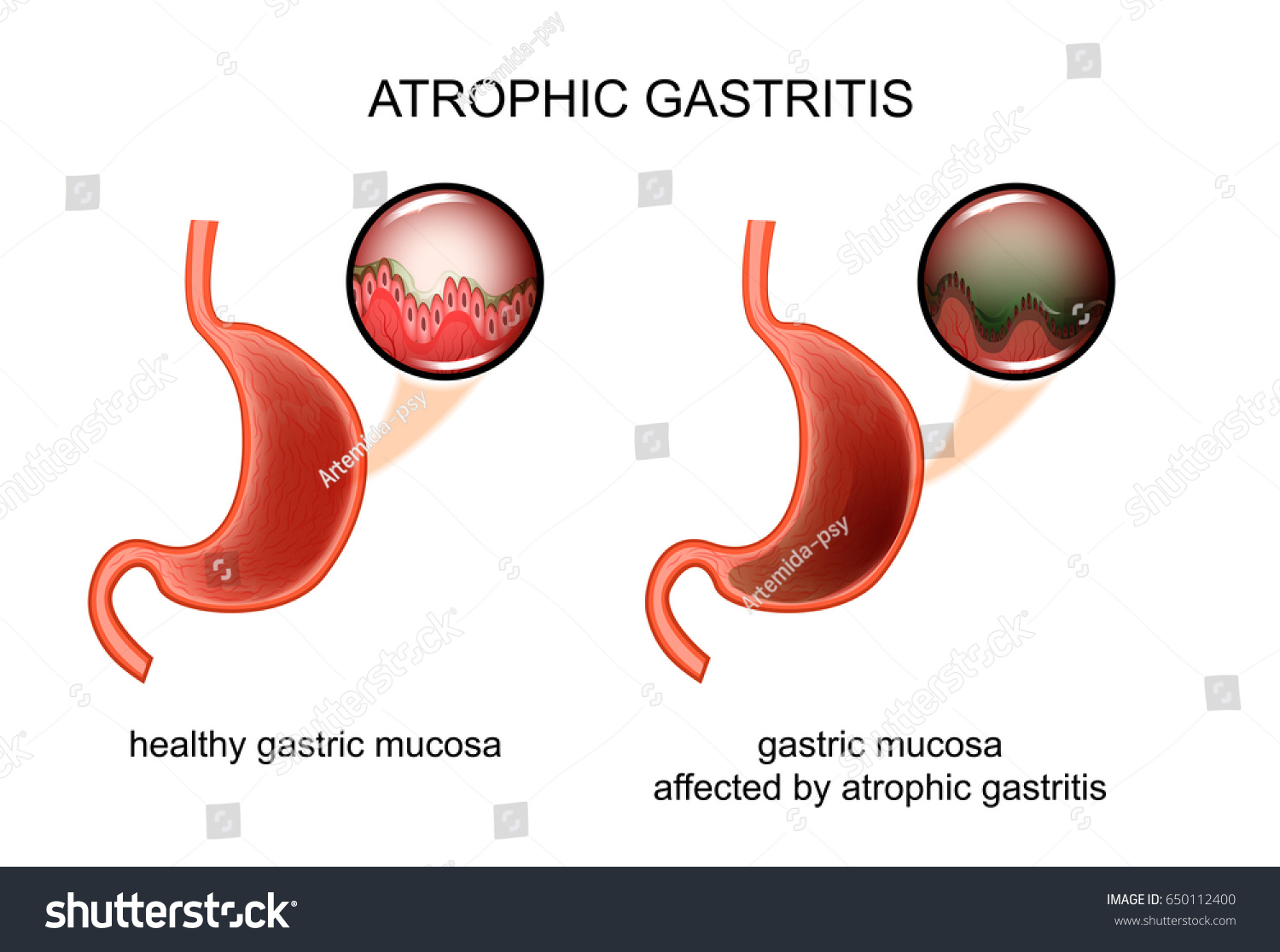 vector-illustration-atrophic-gastritis-inflammation-mucous