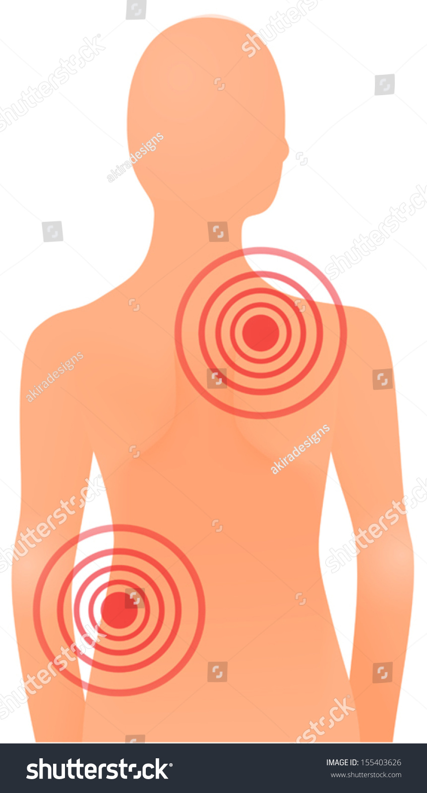 Vector Illustration Back Pain On Shoulder Stock Vector (Royalty Free ...