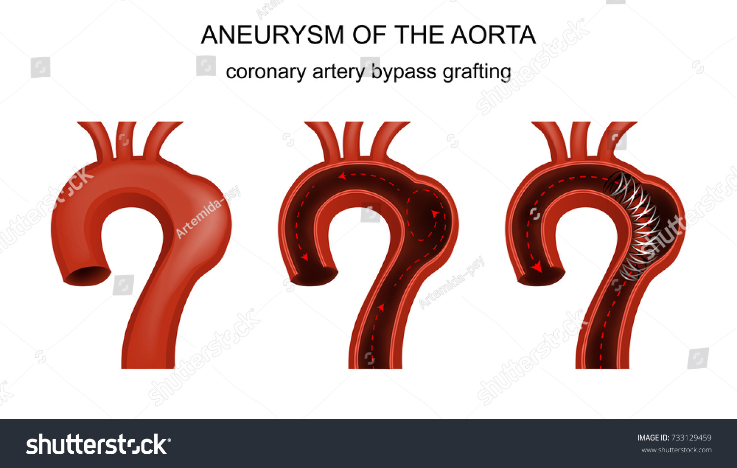 Vector Illustration Coronary Artery Bypass Grafting Stock Vector Vector Illustration Coronary Artery Bypass Grafting Stock Vector