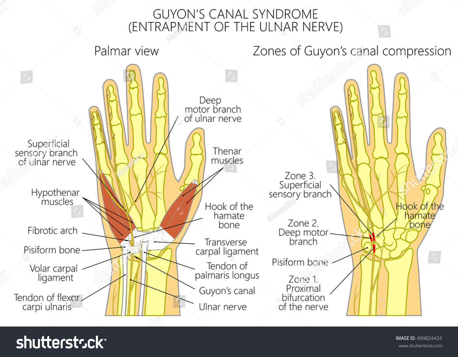 Ulnar Nerve Entrapment Wrist