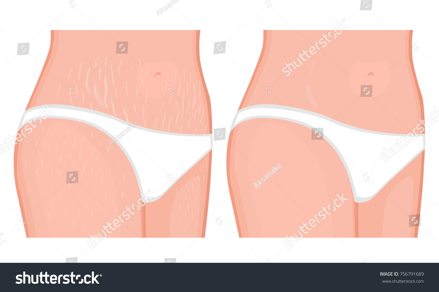 SVG of Vector illustration of human body problem. Healing of stretch marks on European, Asian women belly and legs. For advertising, medical publications, use on package of medicinal products, creams. EPS 8 svg