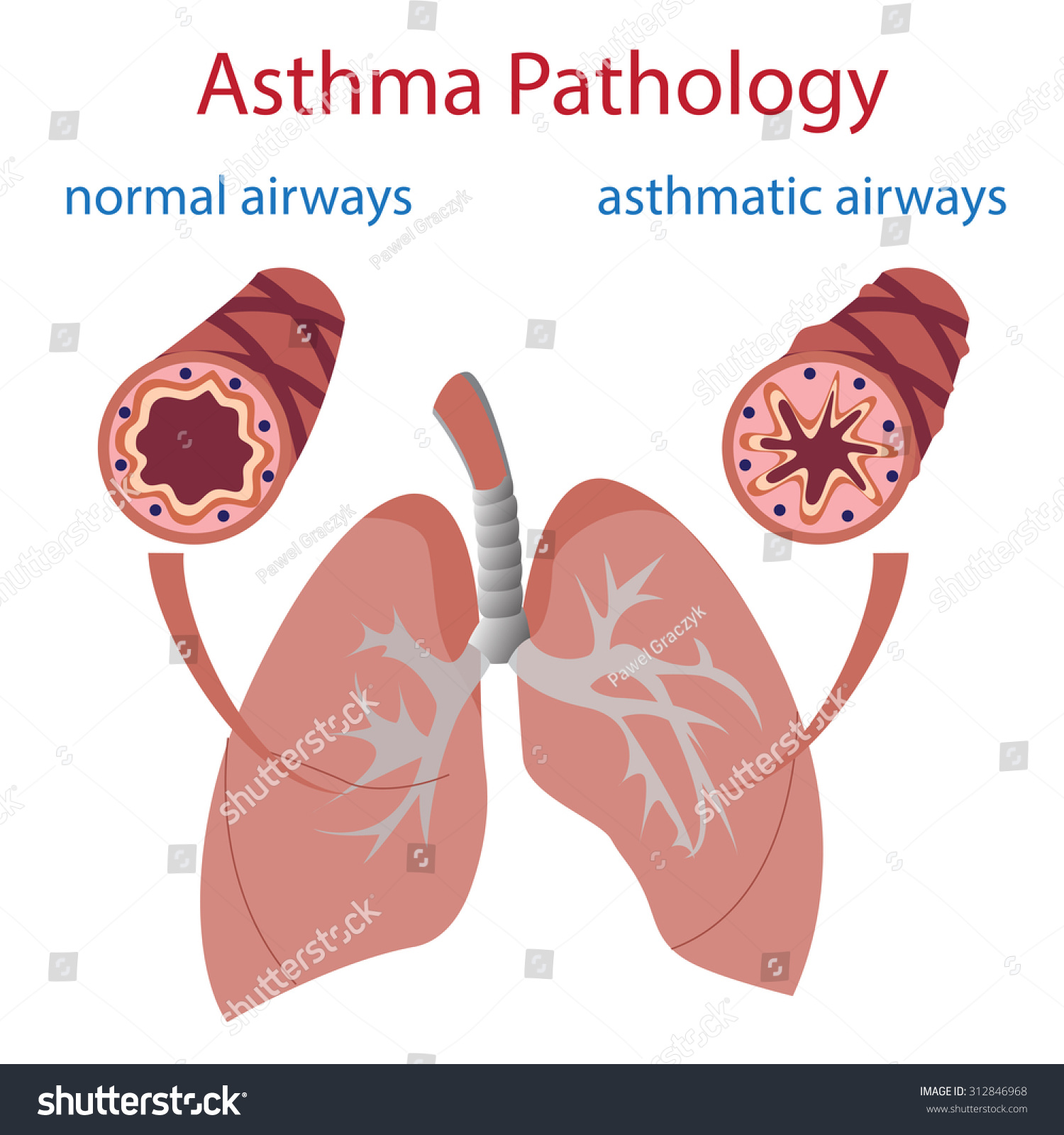 Vector Illustration Of Lungs And Airways Normal And Asthmatic