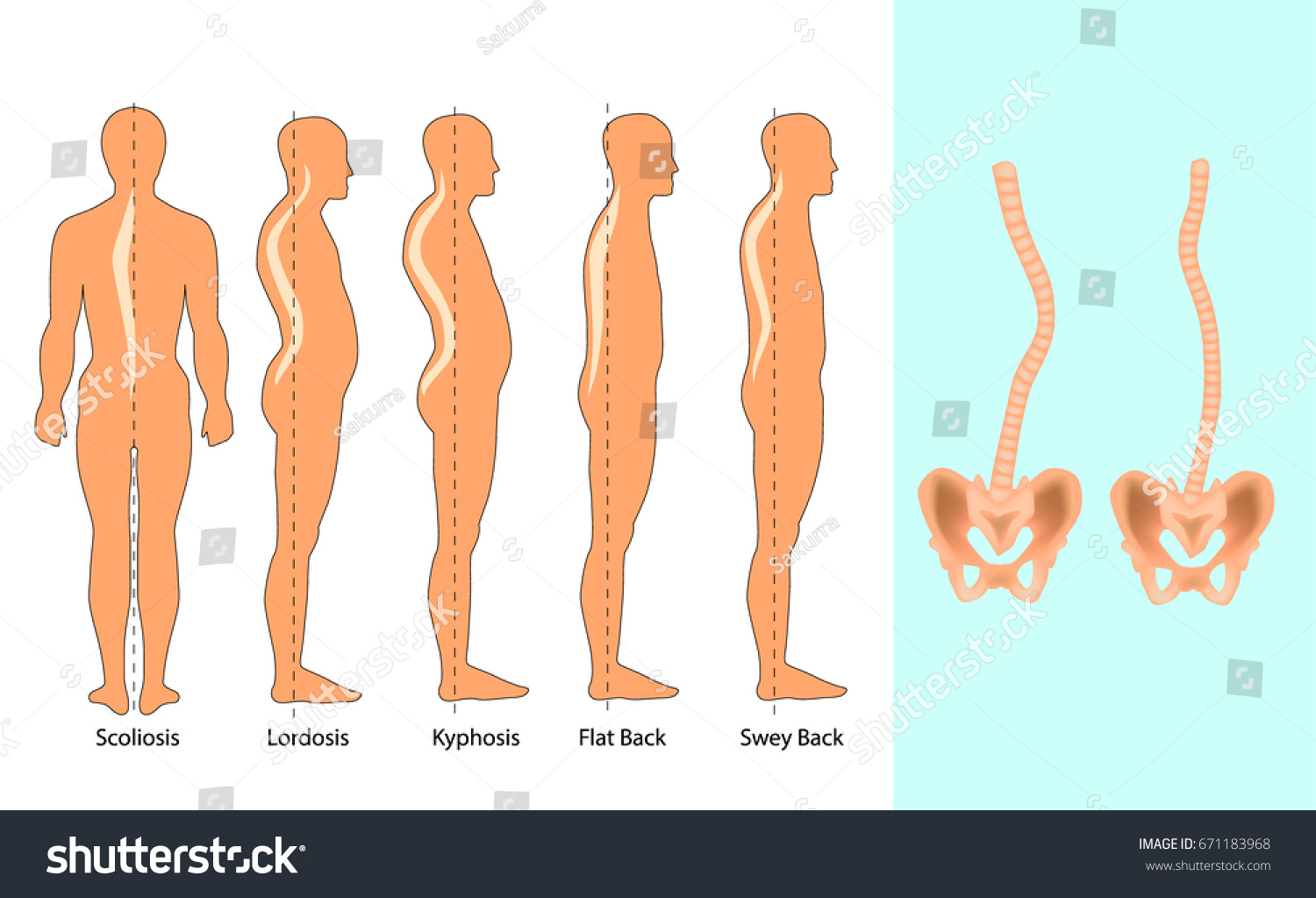 Vector Illustration Spinal Deformity Types Scoliosis Stock Vector ...