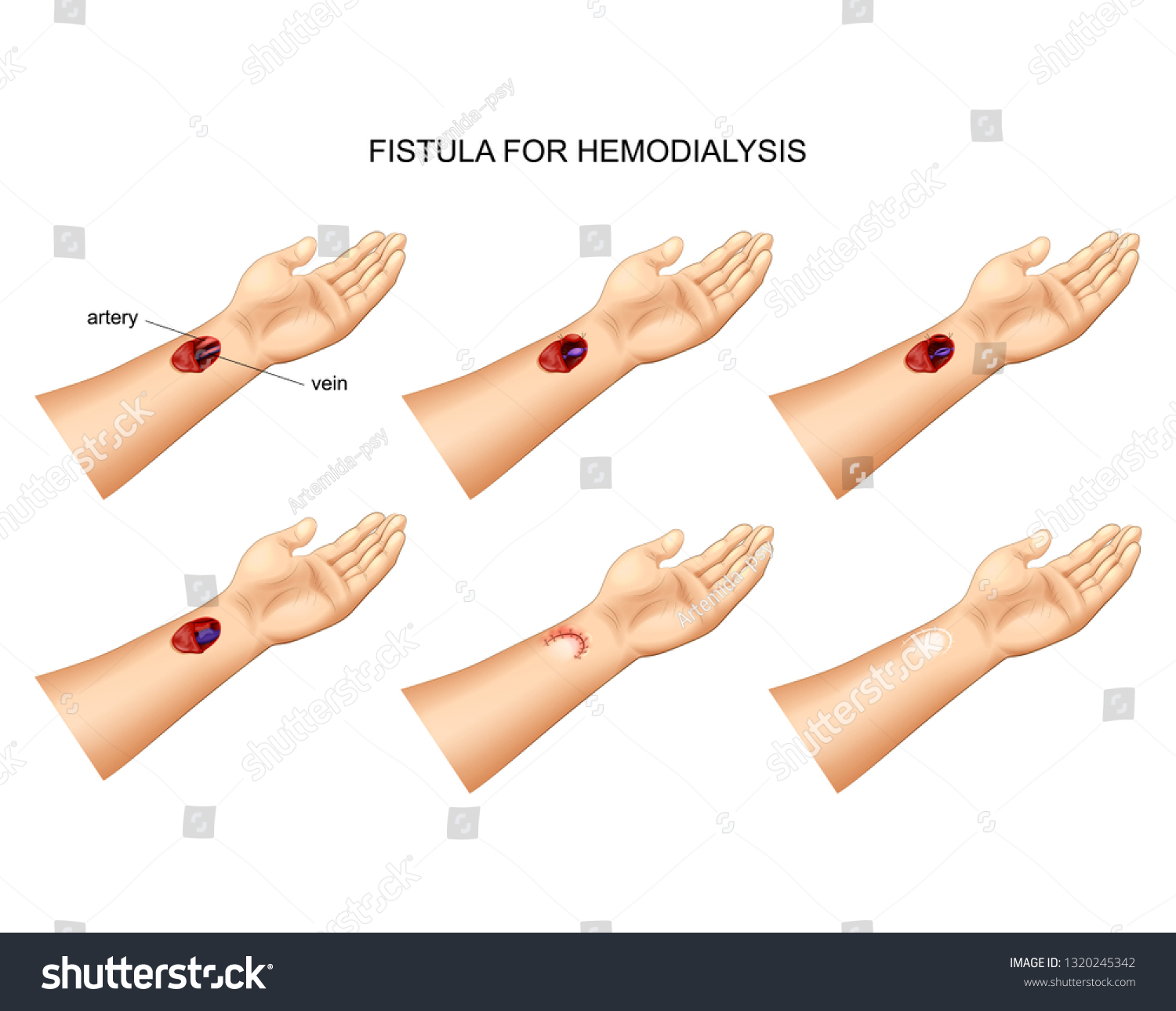 Vector Illustration Installation Fistula Hemodialysis Stock Vector 