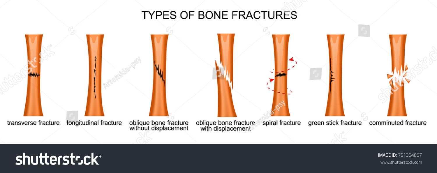 Vector Illustration Types Bone Fractures 库存矢量图（免版税）751354867 Shutterstock 6005