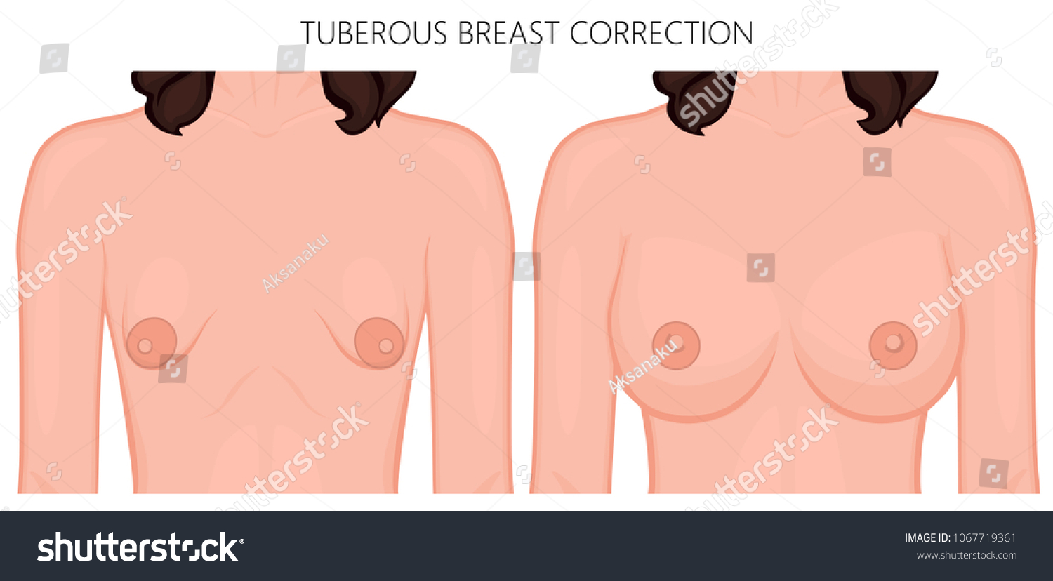 correcting tuberous breasts Fat bottom girl poster