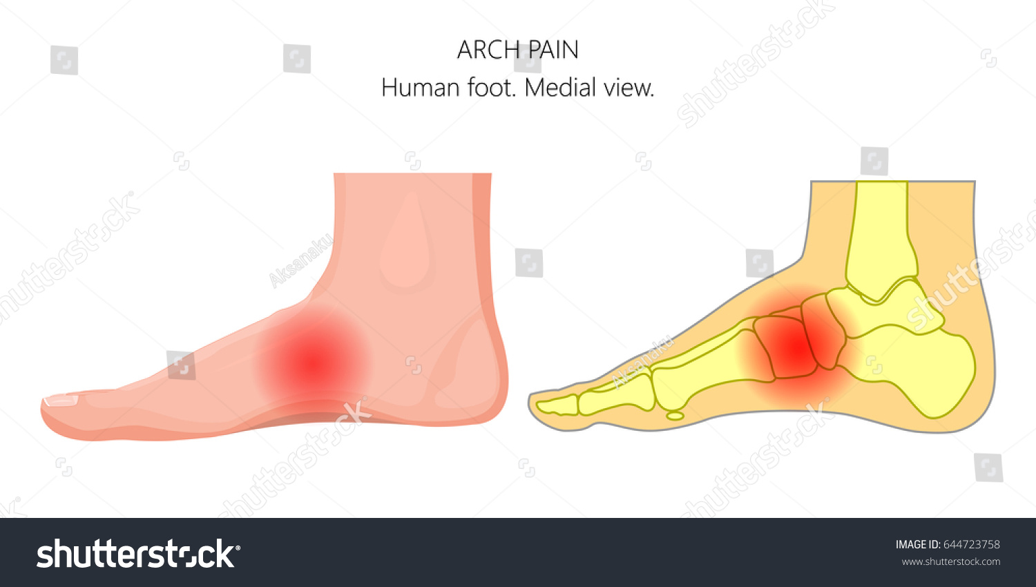 foot medial arch pain