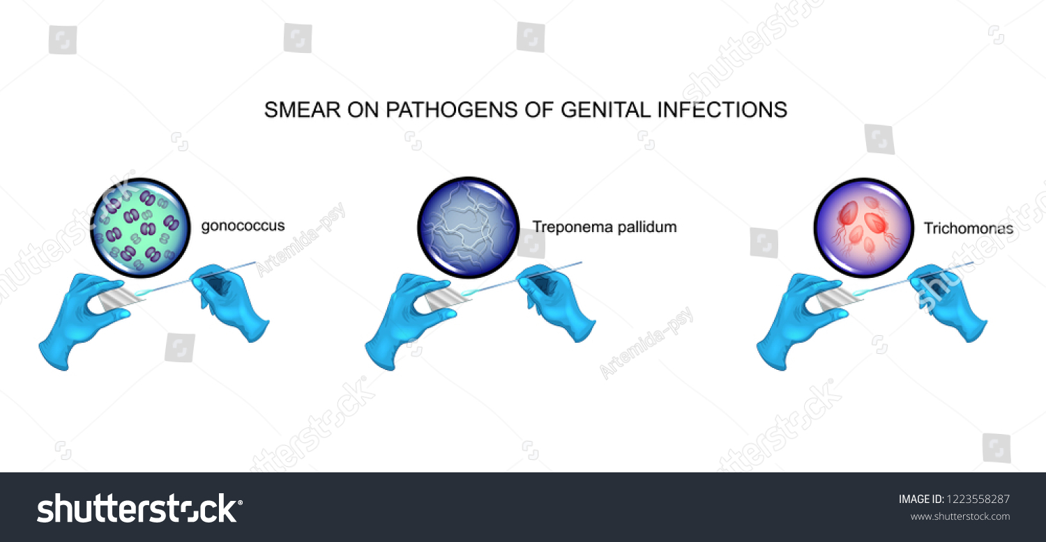 Vector Illustration Urological Smear Gonorrhea Syphilis Image