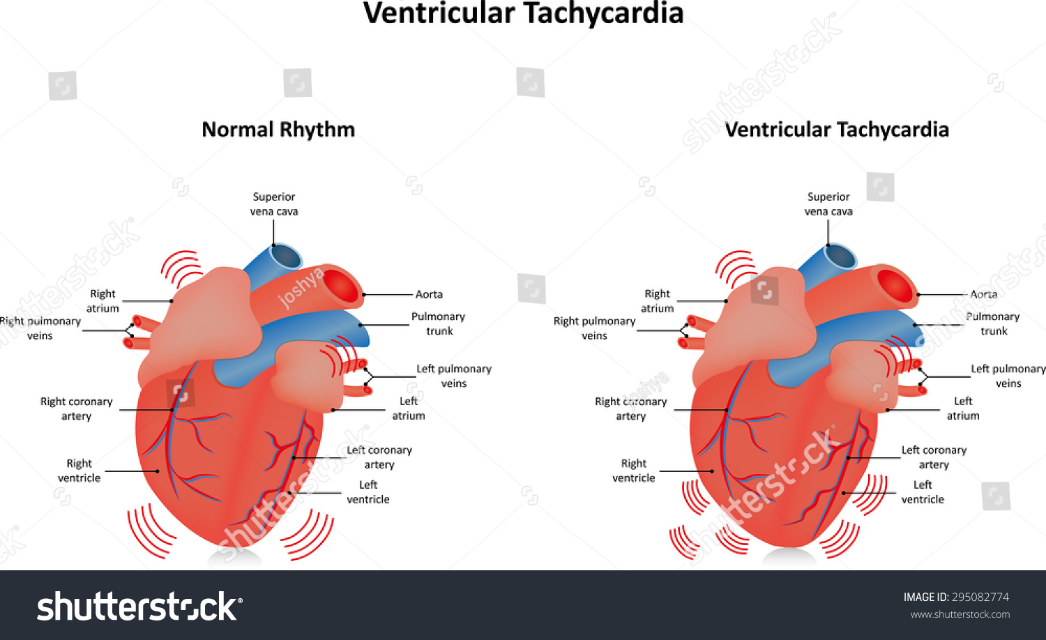 Ventricular Tachycardia Stock Vector Illustration 295082774 : Shutterstock