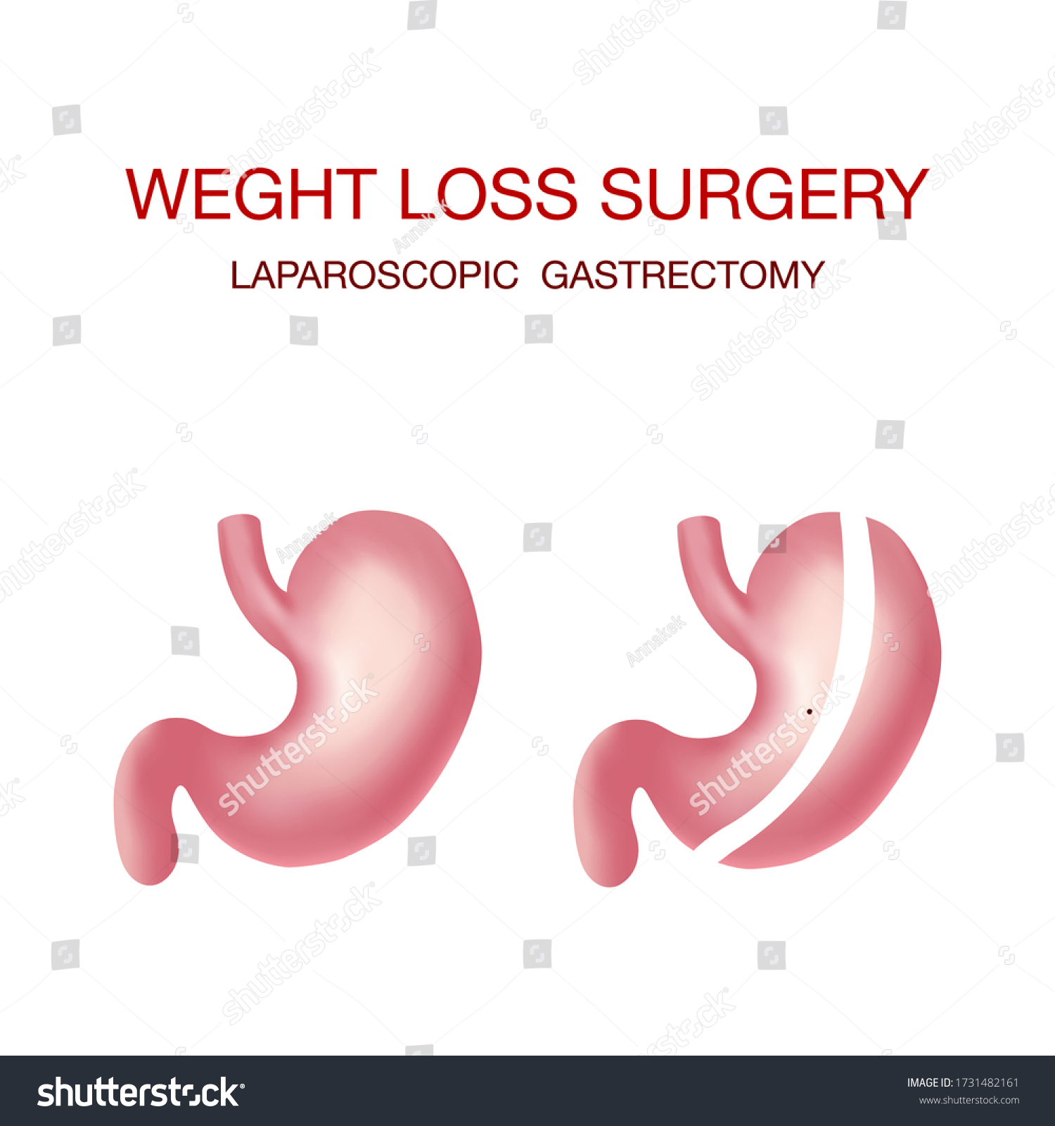 Vertical Sleeve Gastrectomy Medical Vector Illustration Stock Vector Royalty Free 1731482161 1457