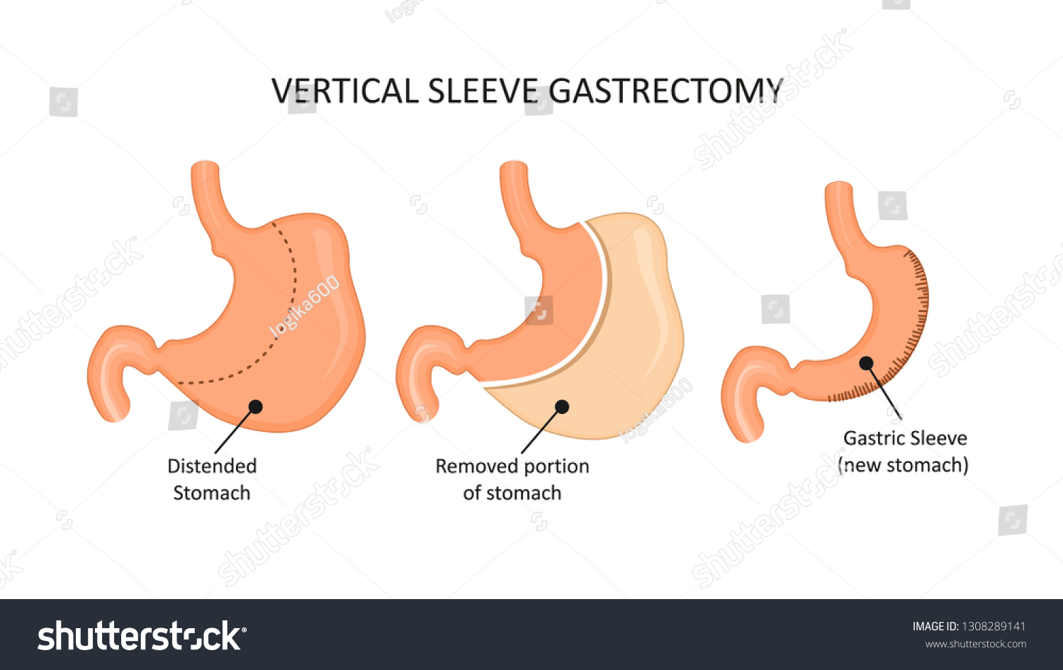 Vertical Sleeve Gastrectomy Stomach Reduction Surgery Stock Vector ...