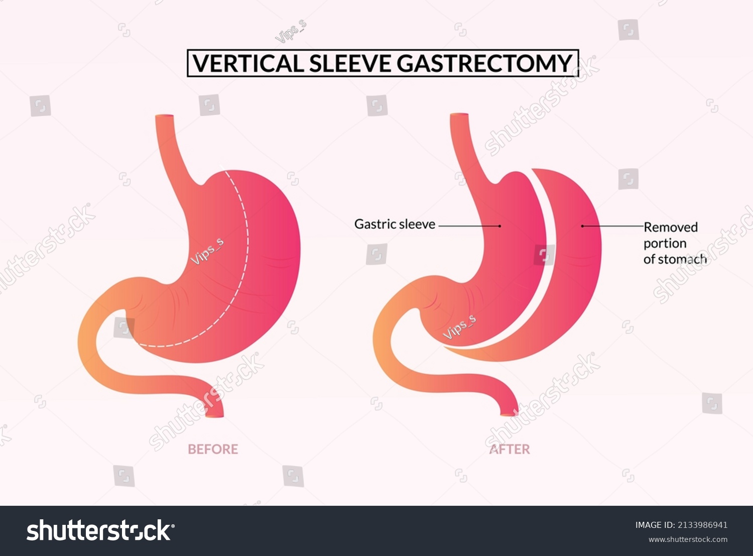 Vertical Sleeve Gastrectomy Surgery Medical Illustration Stock Vector ...