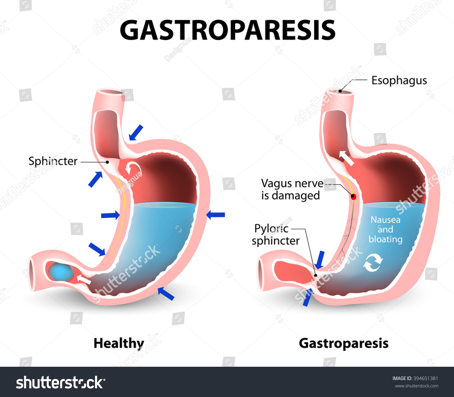 Visual Comparison Of Healthy Gastric And Stomach With Gastroparesis ...