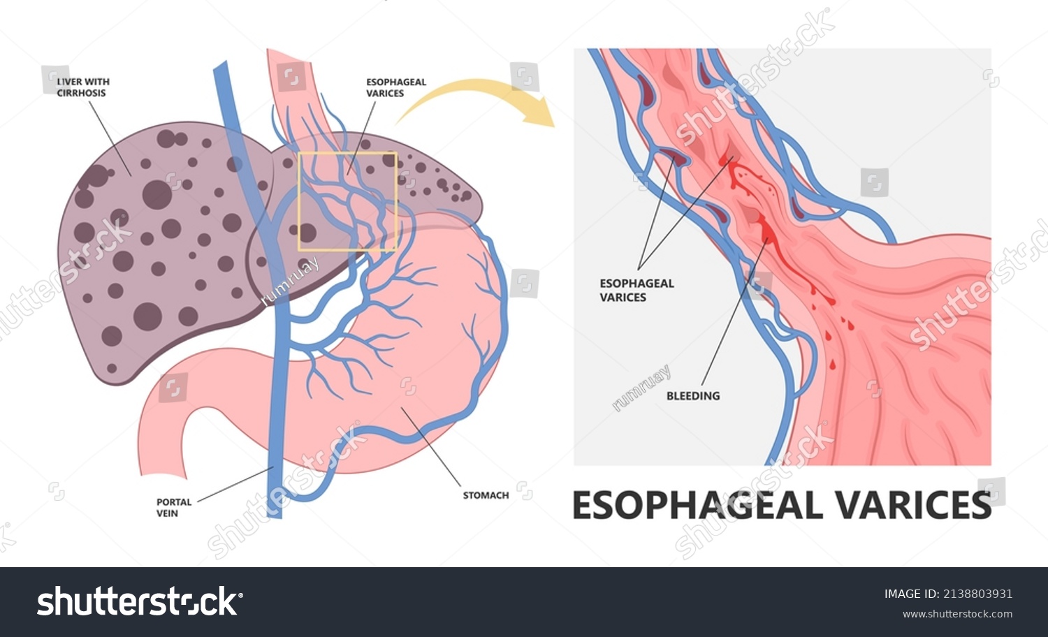 Esophageal Varices Bleeding Model