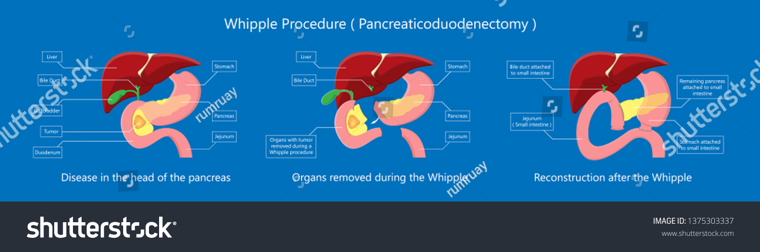 Whipple Procedure Pancreaticoduodenectomy Pancreatic Cancer Treatment