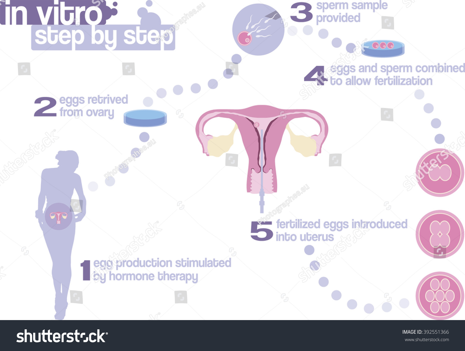 White Big Chart Showing Steps In In Vitro Fertilization With Pictures