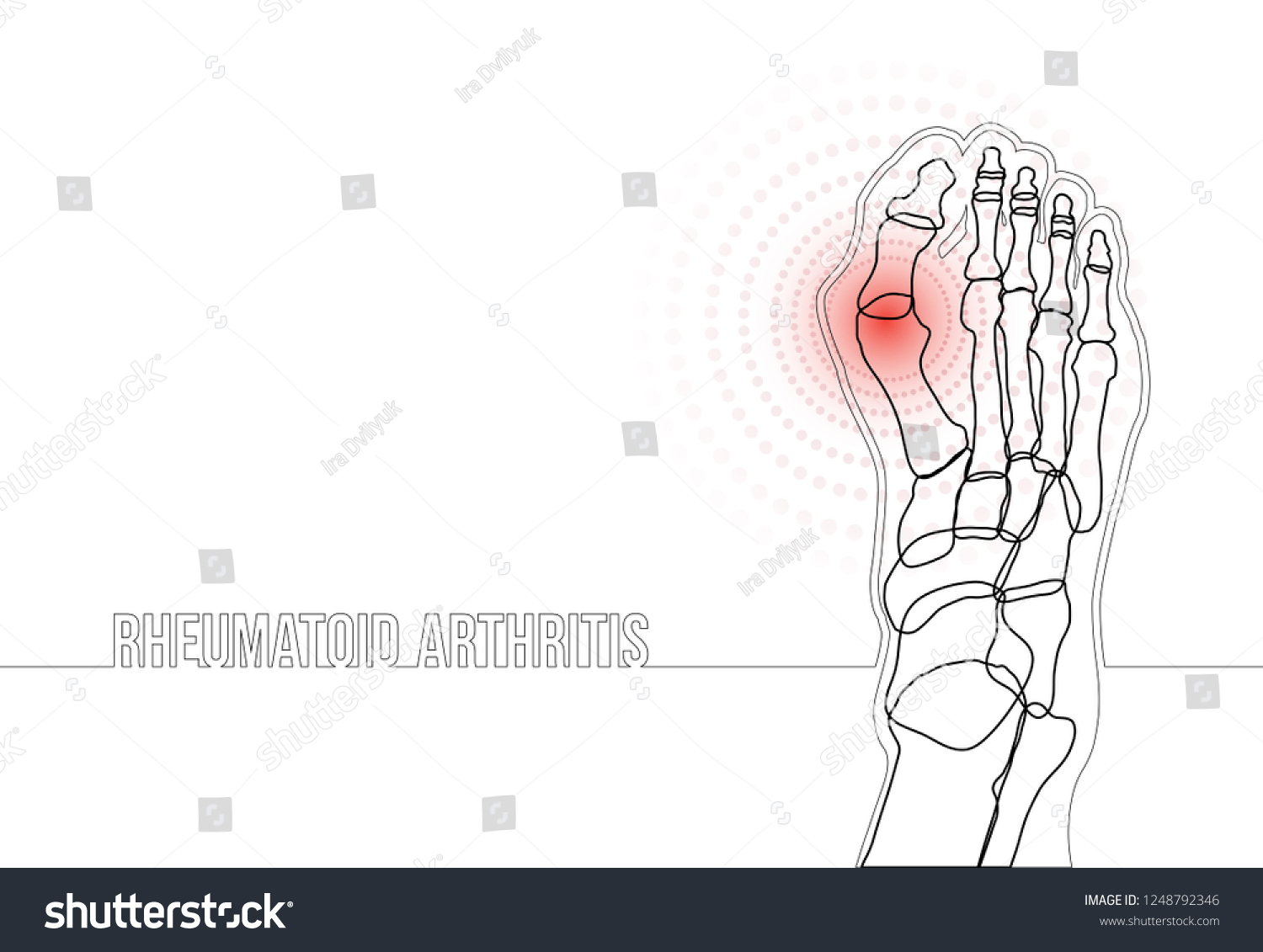 White Horizontal Rheumatoid Arthritis Continuous Line Stock Vector ...