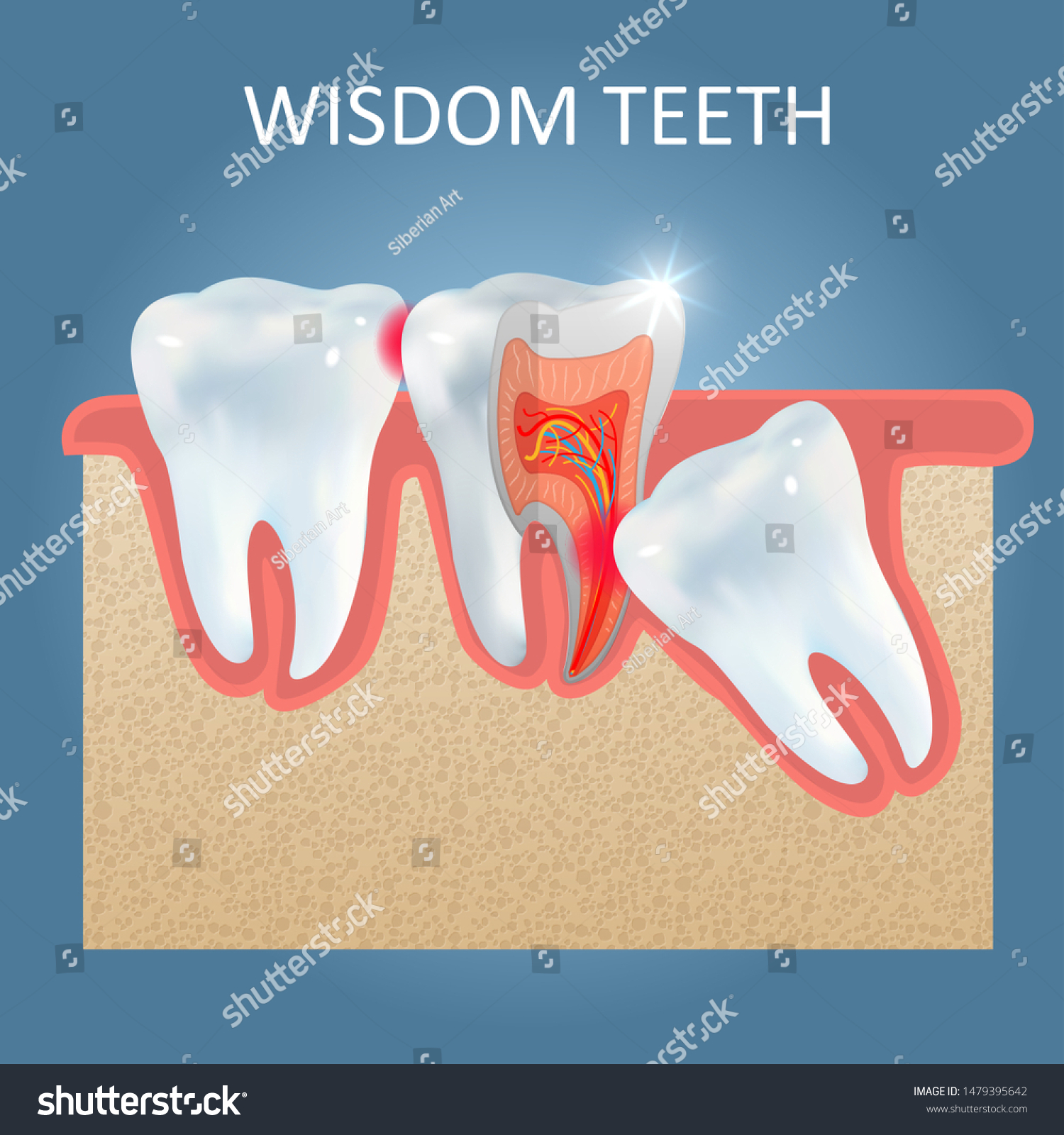 親知らずの歯のポスターテンプレート ベクターリアルイラスト 虫歯や他の歯のう蝕など 歯の問題を引き起こす埋伏智歯 歯の健康のコンセプト のベクター画像素材 ロイヤリティフリー