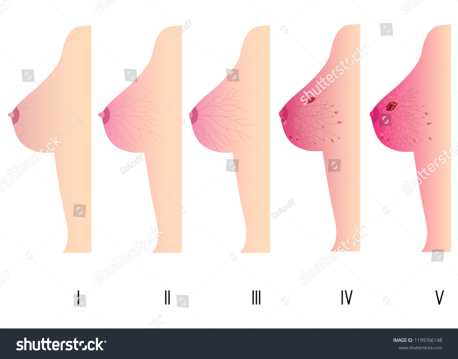 Woman Breast Cancer Stages Pretty Woman Stock Vector Royalty Free 1199766148