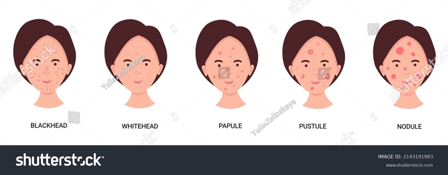 Woman Face Different Type Ache Skin Stock Vector (royalty Free 