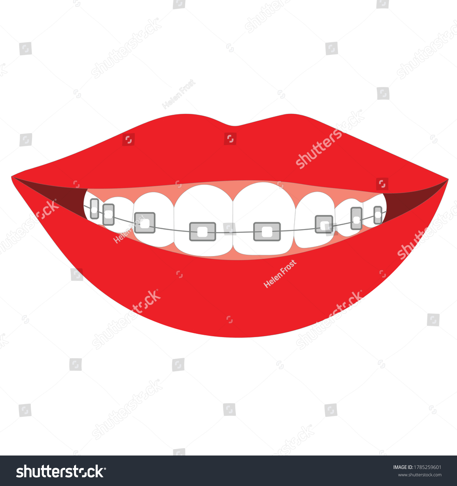 Womans Smile Braces On Her Teeth Stock Vector (Royalty Free) 1785259601 ...