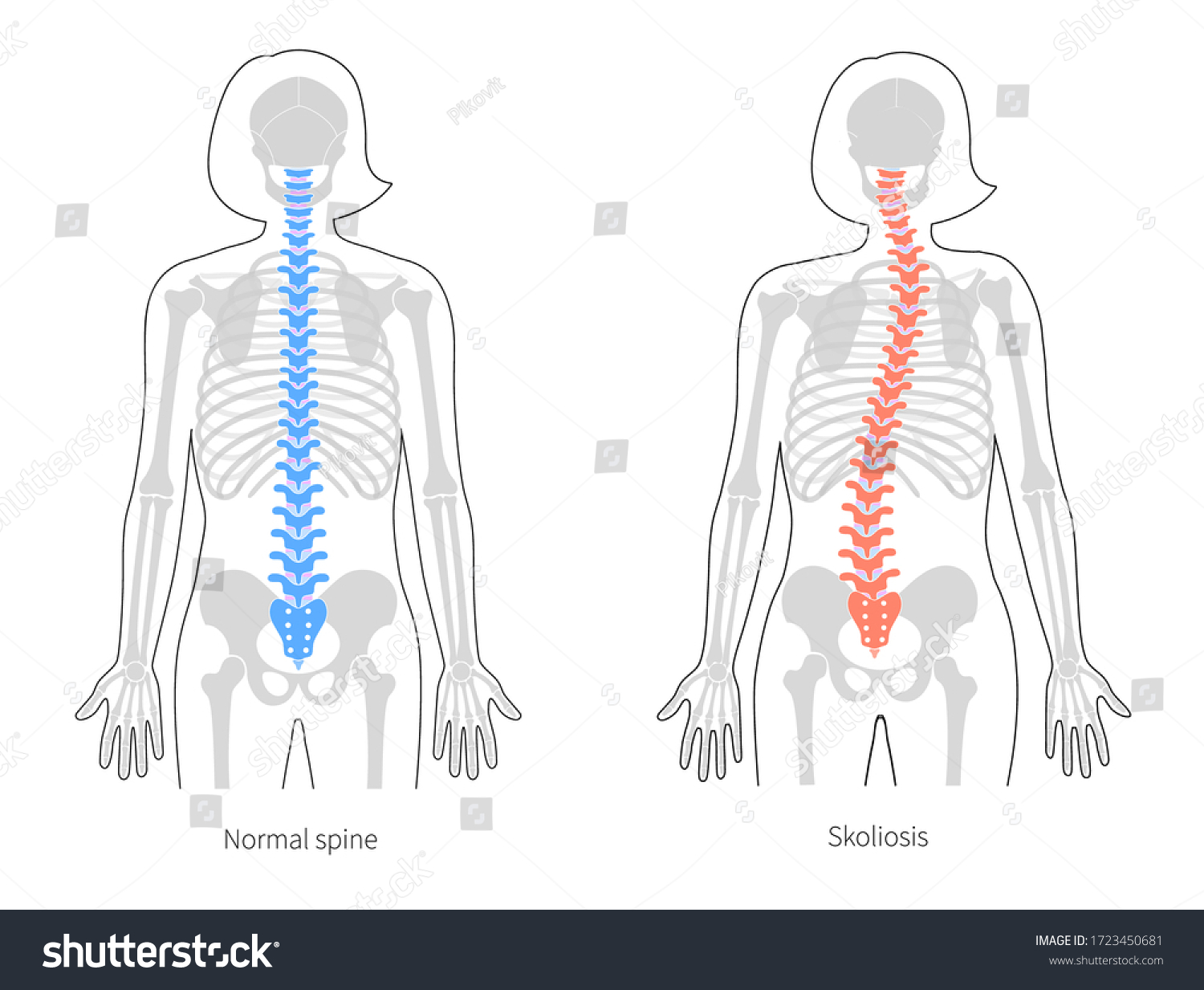 Woman Scoliosis Flat Vector Illustration Types Stock Vector (Royalty ...