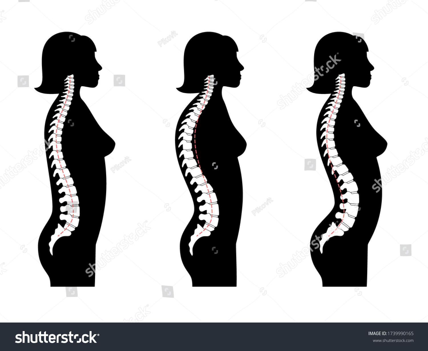 Woman Spinal Deformity Flat Vector Illustration: Vector Có Sẵn (miễn ...