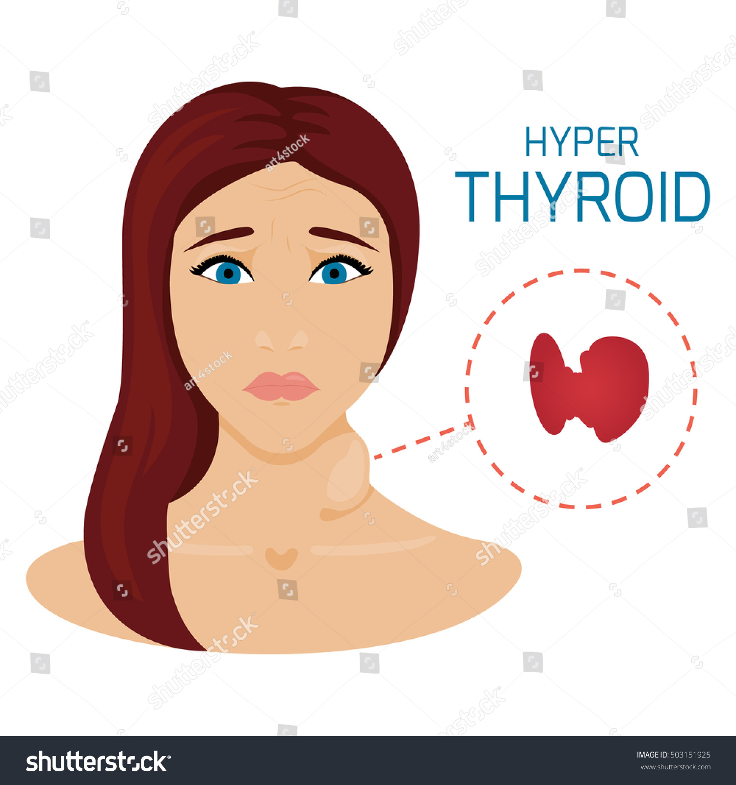 Mujer Con Glándula Hipertiroidea Símbolo Hipertiroidismo Vector De