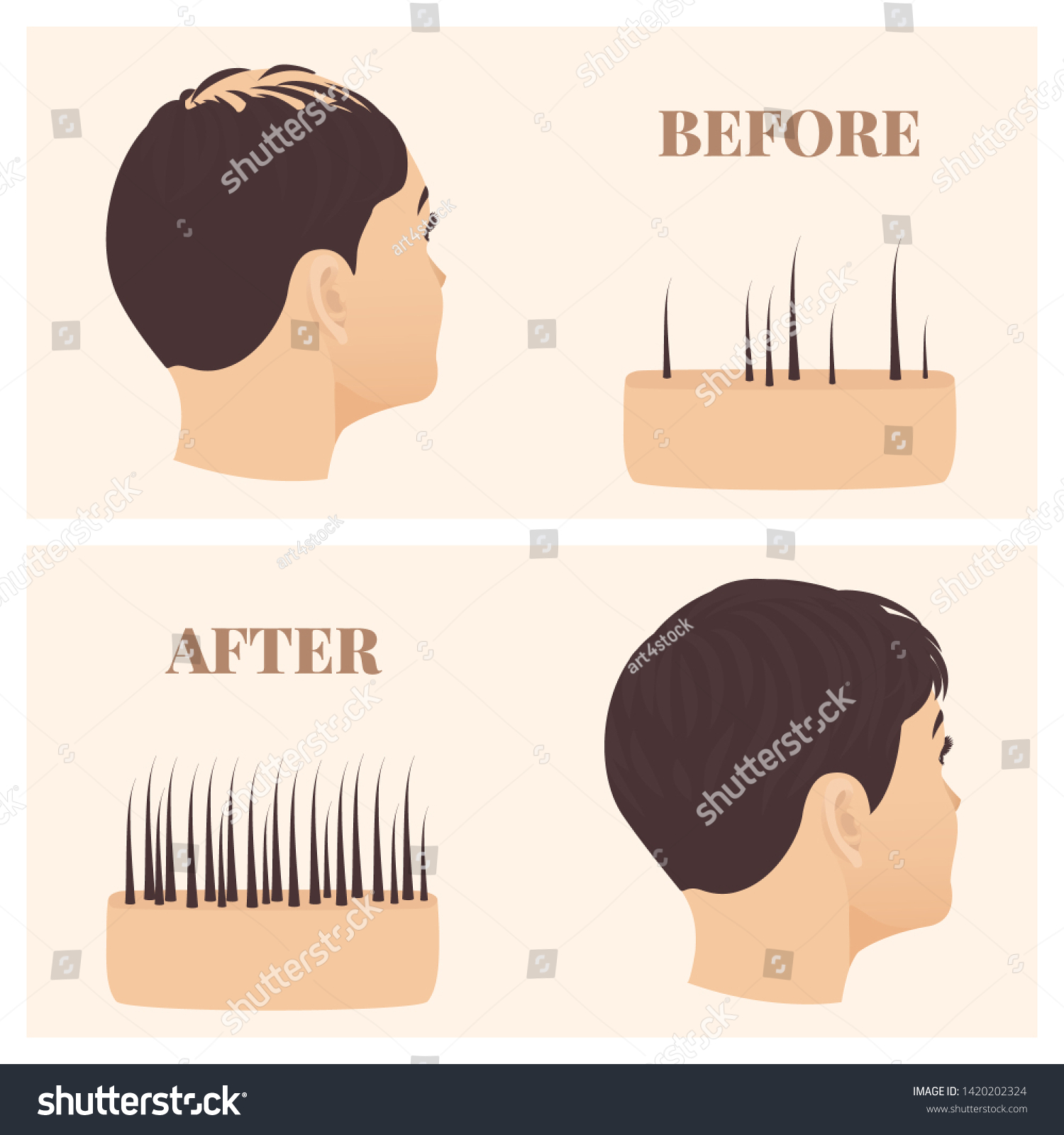 Woman Thinning Hair Before After Hair Stock Vector (Royalty Free