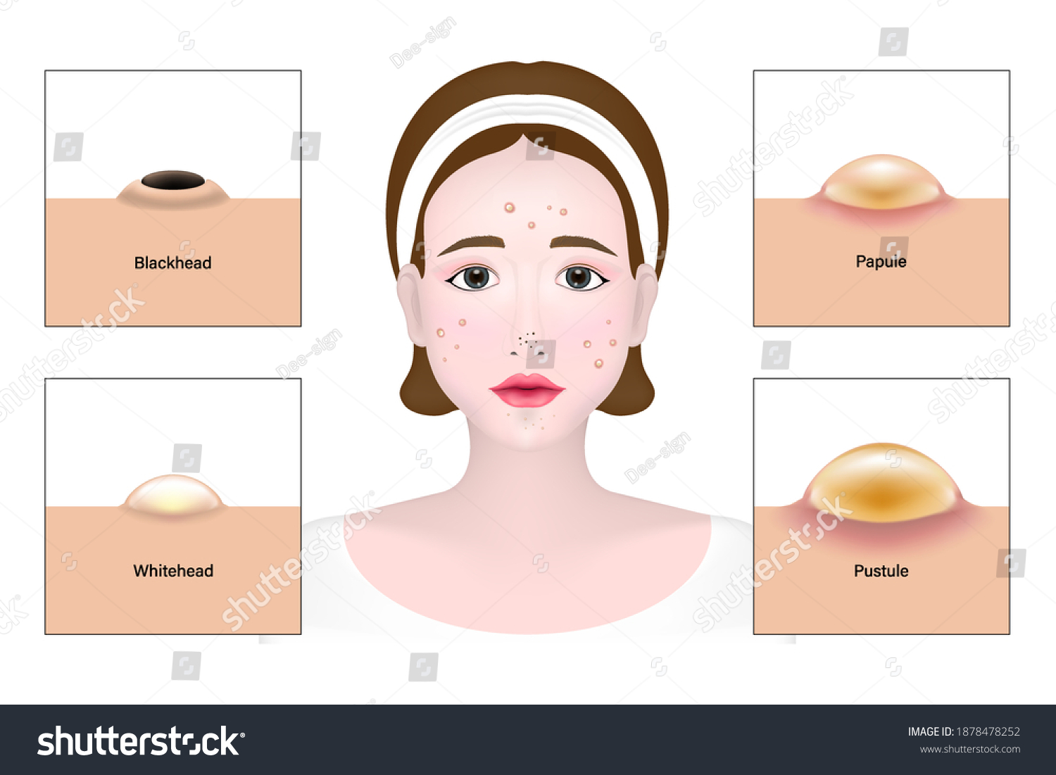 Women Types Acne Skin Problems Vector Stock Vector Royalty Free